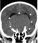 周忠清颅咽管瘤全切的终身复发率,周忠清谈颅咽管瘤术后寿命