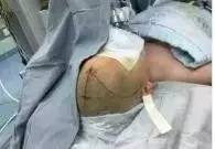 周忠清颅咽管瘤全切的终身复发率,周忠清谈颅咽管瘤术后寿命