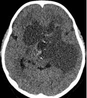 周忠清颅咽管瘤全切的终身复发率,周忠清谈颅咽管瘤术后寿命