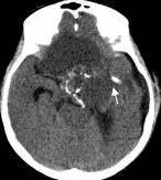 周忠清颅咽管瘤全切的终身复发率,周忠清谈颅咽管瘤术后寿命