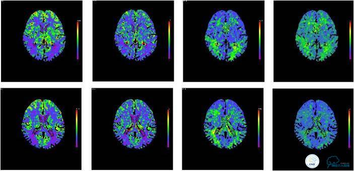 大脑左侧中动脉是主动脉吗,什么是左侧大脑中动脉代偿供血