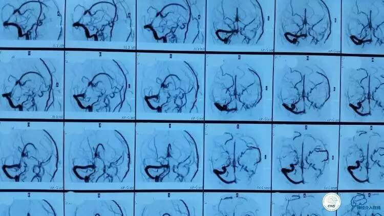 下肢血栓微创介入治疗的费用,急性深静脉血栓形成的诊断和治疗