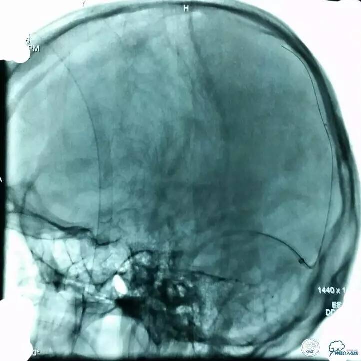 下肢血栓微创介入治疗的费用,急性深静脉血栓形成的诊断和治疗