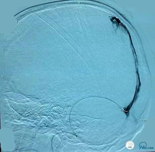 下肢血栓微创介入治疗的费用,急性深静脉血栓形成的诊断和治疗