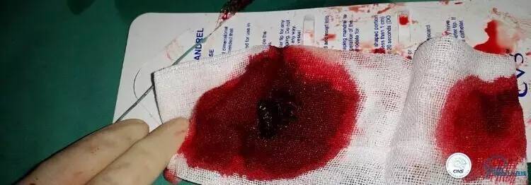 下肢血栓微创介入治疗的费用,急性深静脉血栓形成的诊断和治疗