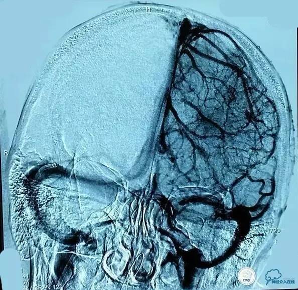下肢血栓微创介入治疗的费用,急性深静脉血栓形成的诊断和治疗