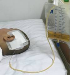 周忠清颅咽管瘤全切的终身复发率,周忠清谈颅咽管瘤术后寿命