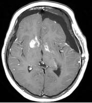 周忠清颅咽管瘤全切的终身复发率,周忠清谈颅咽管瘤术后寿命