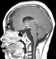 周忠清颅咽管瘤全切的终身复发率,周忠清谈颅咽管瘤术后寿命