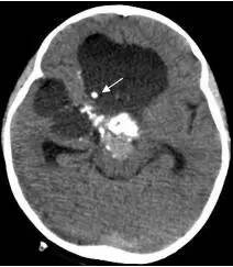 周忠清颅咽管瘤全切的终身复发率,周忠清谈颅咽管瘤术后寿命