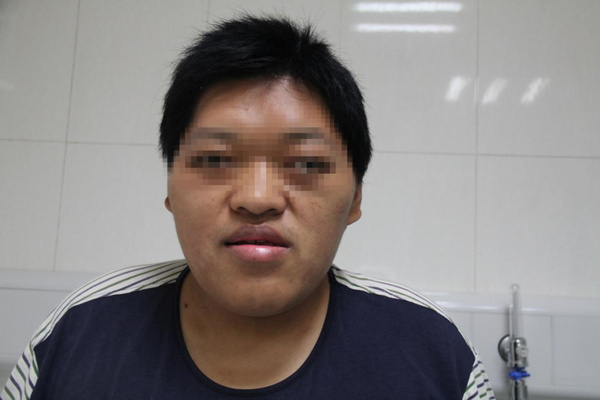 垂体微腺瘤死亡率,青春期垂体微腺瘤