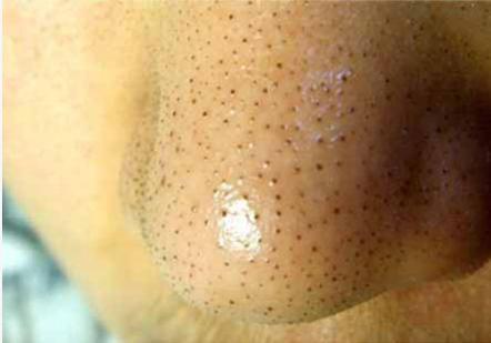 黑头反复长是什么原因,黑头为什么老是反复