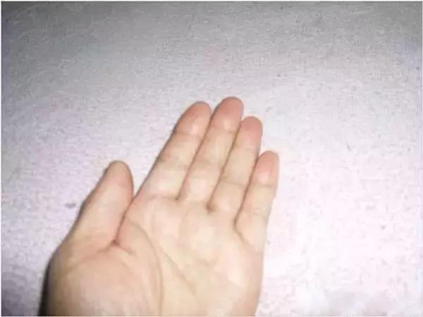 香虎烧手如何治疗的,香虎手能彻底治好吗