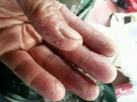 香虎烧手如何治疗的,香虎手能彻底治好吗