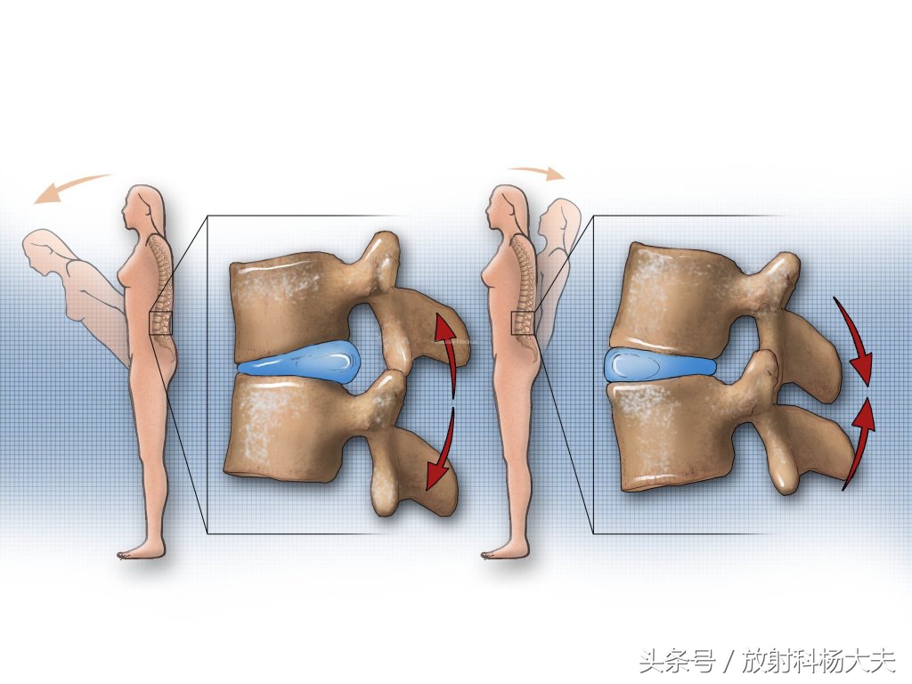 除了腰间盘突出还有什么导致腰疼,除了腰间盘突出别的都不突出