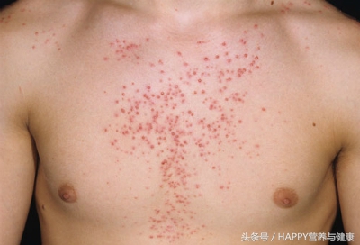 皮肤科怎么治疗长疮,皮肤疮的症状有哪些