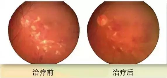 视网膜静脉阻塞能治好吗,视网膜静脉血管堵塞的十大征兆