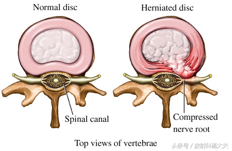 除了腰间盘突出还有什么导致腰疼,除了腰间盘突出别的都不突出