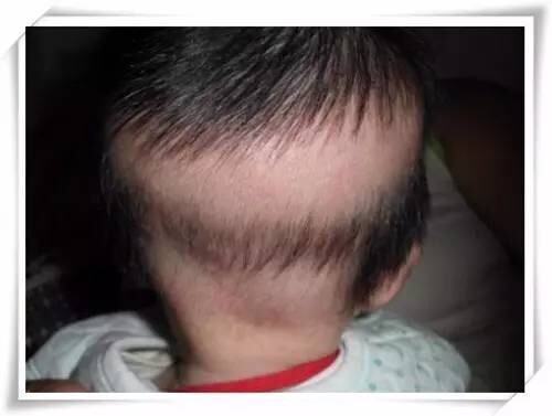 怎么看孩子有没有过量补钙,缺钙补钙的误区