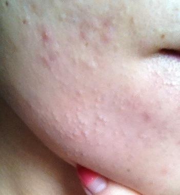 宝宝毛孔粗大是怎么回事,什么导致小孩毛孔粗大