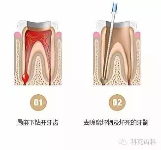 抽神经根管治疗视频,根管治疗全过程抽牙神经