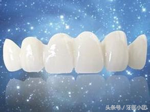 镶牙树脂和全瓷哪种材料好,镶牙哪种材料最好