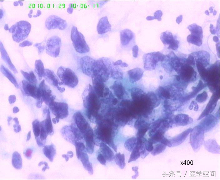 中国宫颈活检报告,宫颈细胞学诊断结果及意义