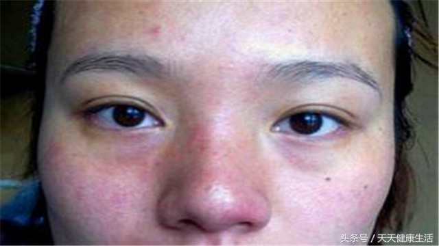 女孩眼睛角膜溃疡,小朋友眼角膜红是什么原因怎么办