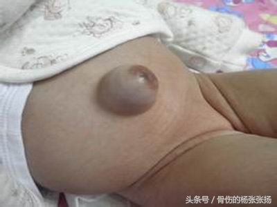 如何预防疝气手术后复发,怎样避免疝气手术后复发