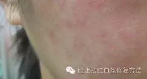 皮肤过敏如何日常修复,皮肤粘胶带过敏用什么方法不过敏