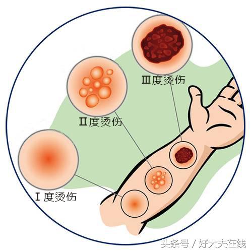 被烫了紧急处理方法,被烫到怎么办用什么药