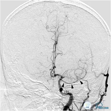 大脑左侧中动脉是主动脉吗,什么是左侧大脑中动脉代偿供血