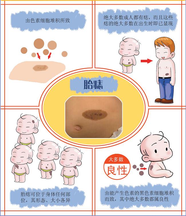 宝宝身上有哪些胎记,有胎记的小孩儿是不是天使