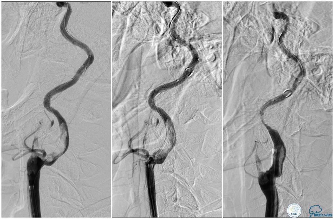 一例颈动脉栓塞的血管内介入治疗