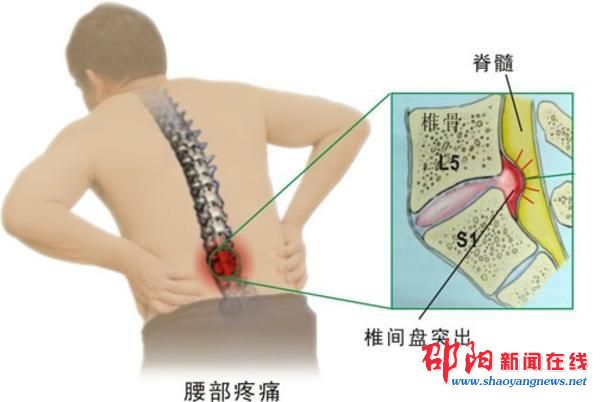 康复治疗中心腰突,康复科医生腰间盘突出