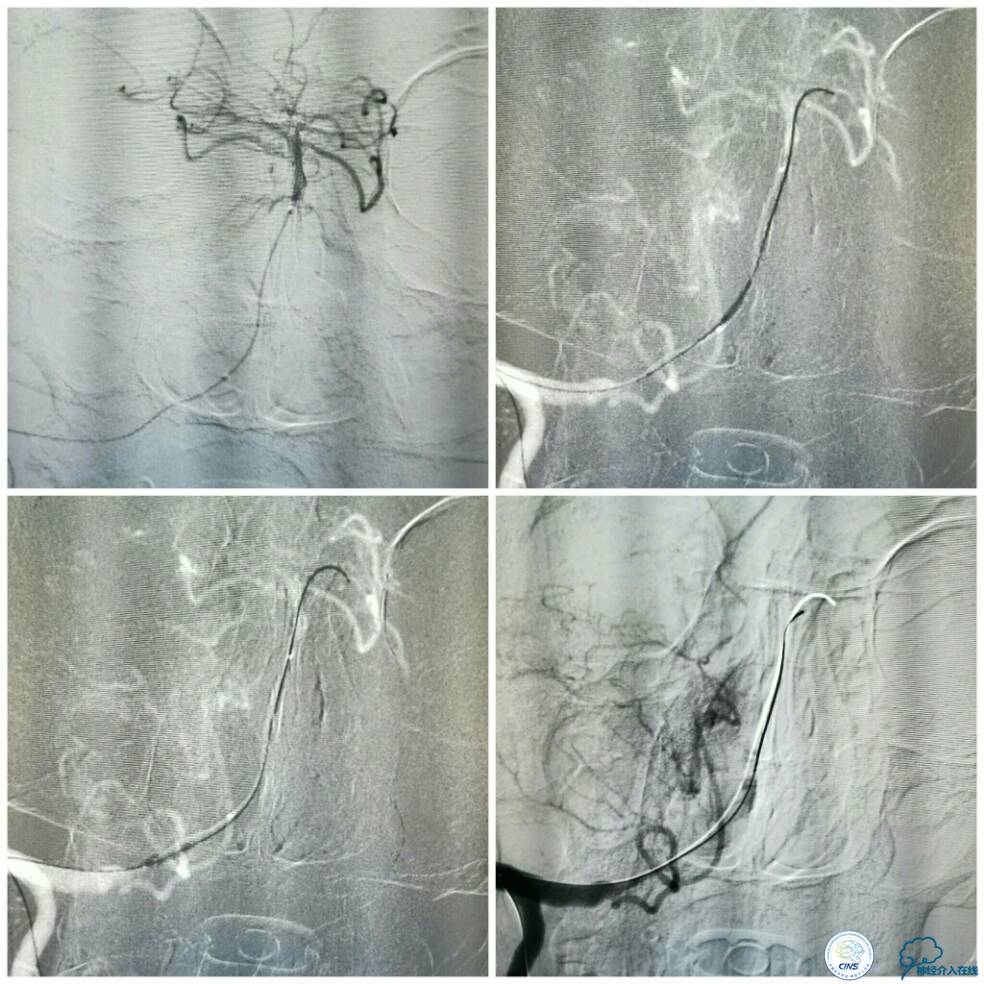 天坛周记|右椎动脉V4段慢性闭塞血管内介入治疗再通一例