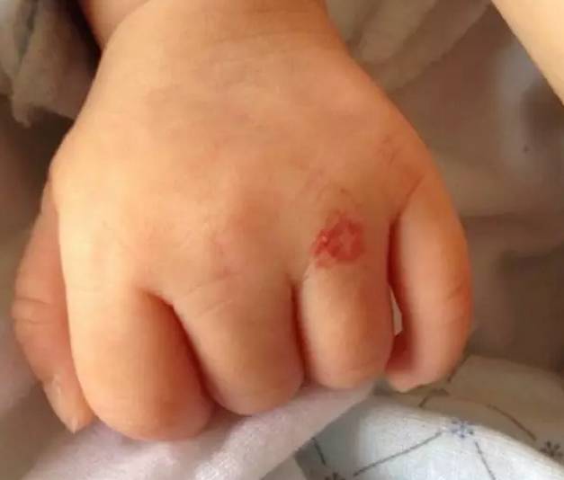 宝宝身上有哪些胎记,有胎记的小孩儿是不是天使