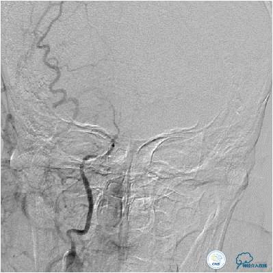 大脑左侧中动脉是主动脉吗,什么是左侧大脑中动脉代偿供血
