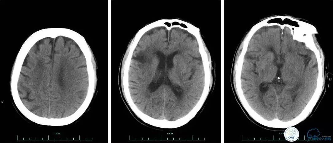 一例颈动脉栓塞的血管内介入治疗