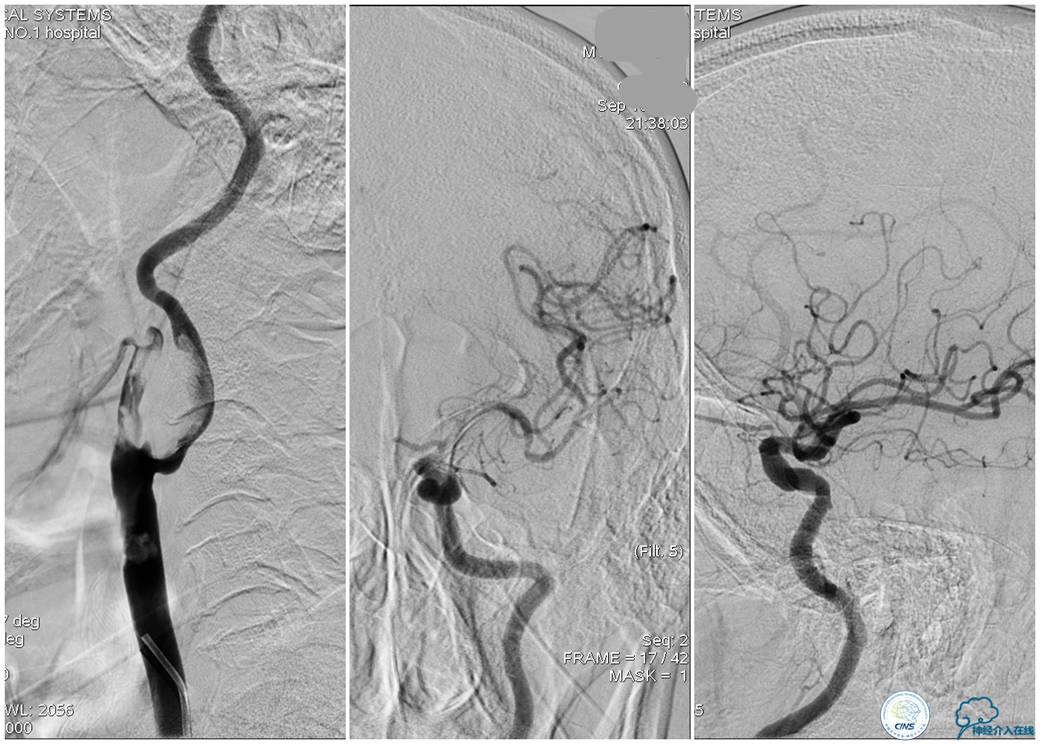 一例颈动脉栓塞的血管内介入治疗