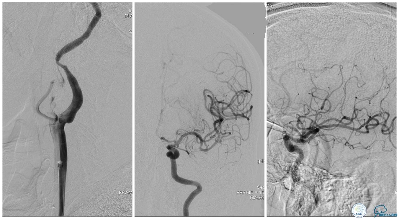 一例颈动脉栓塞的血管内介入治疗
