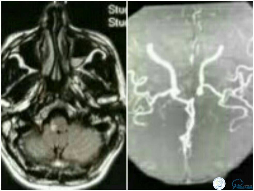 天坛周记|右椎动脉V4段慢性闭塞血管内介入治疗再通一例