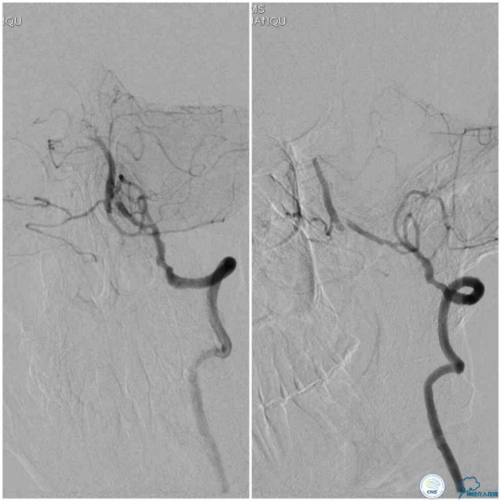 天坛周记|右椎动脉V4段慢性闭塞血管内介入治疗再通一例
