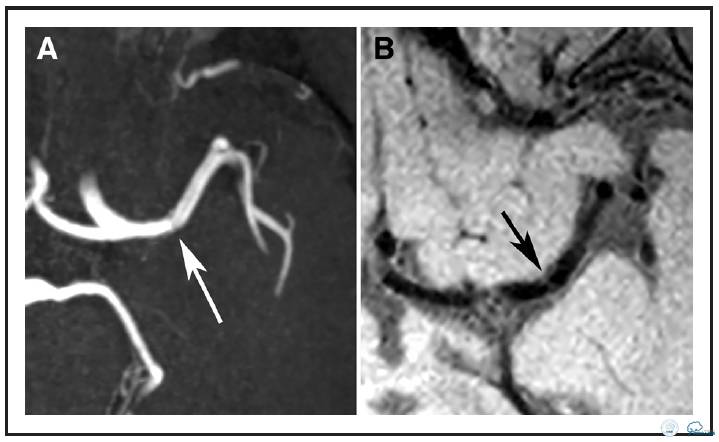 动脉粥样硬化疾病的影像诊断,脑动脉粥样硬化大脑的形态学变化