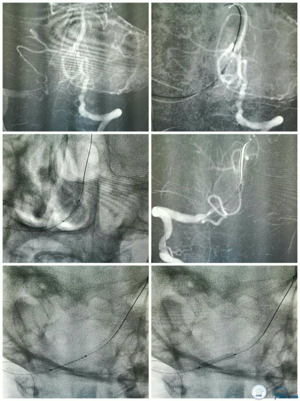 天坛周记|右椎动脉V4段慢性闭塞血管内介入治疗再通一例