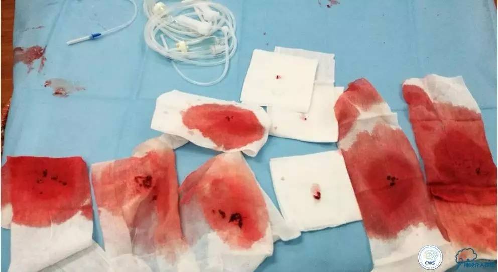 一例颈动脉栓塞的血管内介入治疗