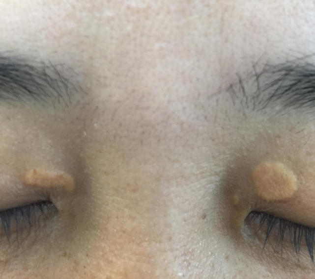 眼皮上有肉疙瘩是血脂高吗,眼皮上长了个小疙瘩是血脂高吗