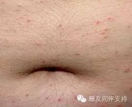 糖尿病友预防肾病，听台湾卫都师的建议