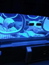 成人先天性非溶血性黄疸怎样鉴别,病理性黄疸会引起脑瘫吗