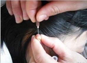 得了麦粒肿不用担心，中医治疗有秘诀